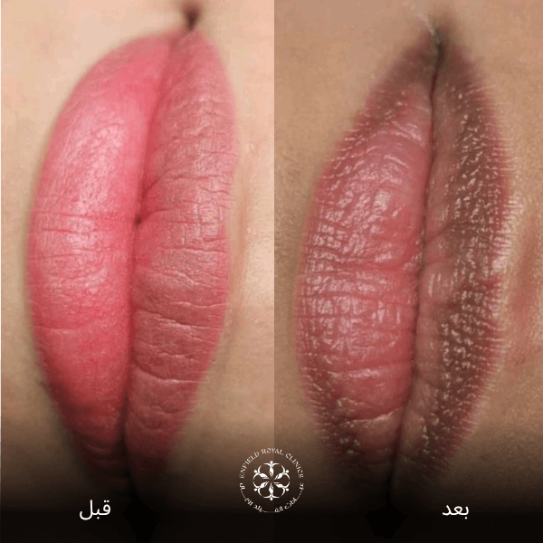 شفاه المدخن قبل وبعد4